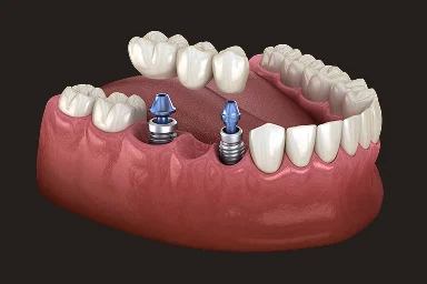 Implant-supported dental bridge illustration