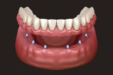 Implant-supported dentures illustration
