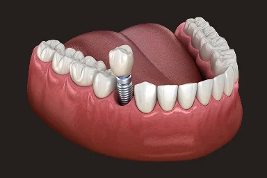 Single dental implant replacing a missing tooth
